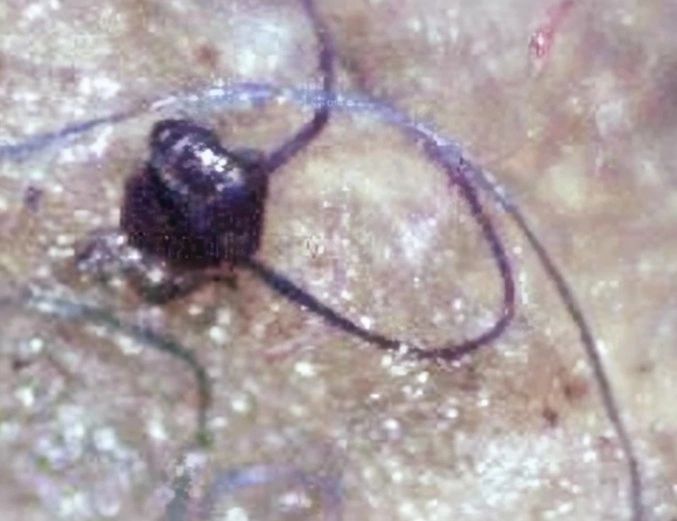 alien-implants-are-real